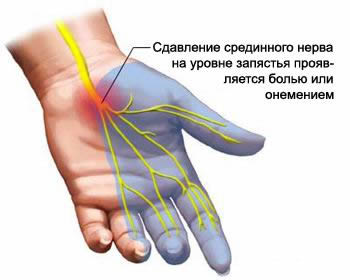 Place of compression of the median nerve in tunnel syndrome at the level of the carpal tunnel.